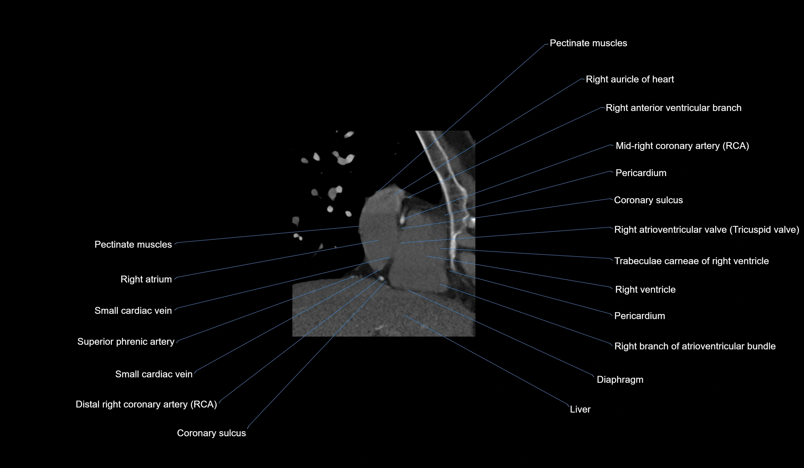 CT heart (coronary angiogram) 2 chamber view cross sectional anatomy labelled radiology image-00035.webp